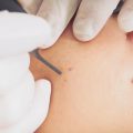 Skin tag removal cost in India and health insurance coverage