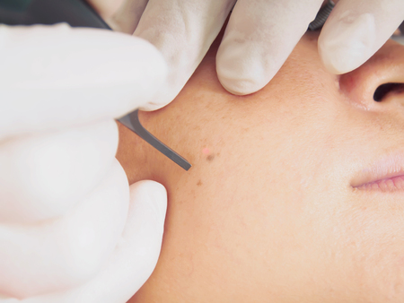 Skin tag removal cost in India and health insurance coverage