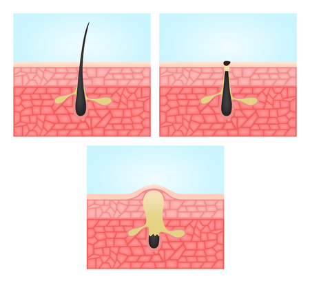 Factors Unique to Indian Skin and Hair Types
