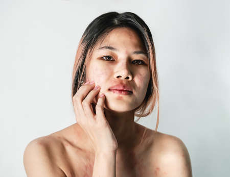 Skin Care Tips for Indian Men: Botox Treatment and Aftercare
