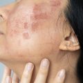 Effects of Hormonal Changes on Melasma in Indian Women